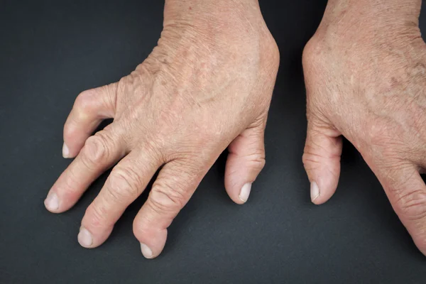 Rheumatoid arthritis hands — Stock Photo, Image