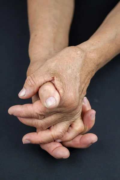Revmatoidní artritida rukou — Stock fotografie