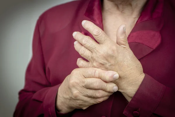 Reumatoid artrit händer — Stockfoto