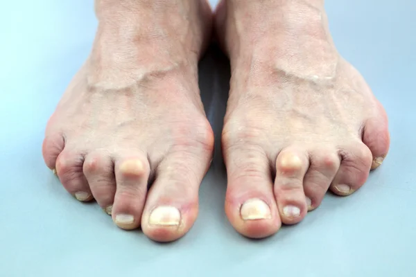 Feet Of Woman Deformed From Rheumatoid Arthritis — Stock Photo, Image