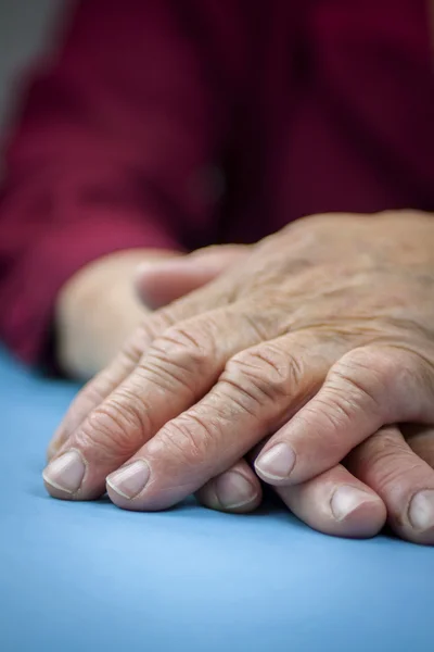 Artrite reumatoide mãos — Fotografia de Stock