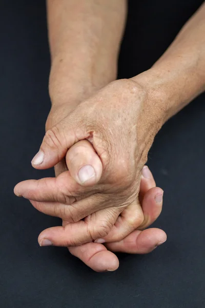 Rheumatoid arthritis hands Stock Image