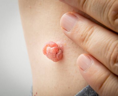 Sıvı nitrojenle yapılan tıbbi dermatolog tedavisinden şişmiş ve büyümüş bir insan vücudundaki deri ya da deri beninin yakın fotoğrafını çek. Deri benini aldırdım. Dermatolojik güzellik tedavisi