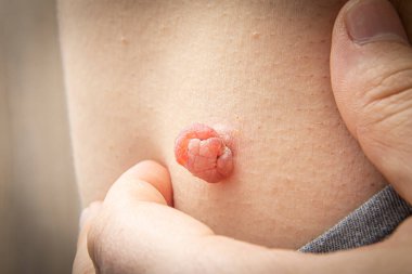 Sıvı nitrojenle yapılan tıbbi dermatolog tedavisinden şişmiş ve büyümüş bir insan vücudundaki deri ya da deri beninin yakın fotoğrafını çek. Deri benini aldırdım. Dermatolojik güzellik tedavisi