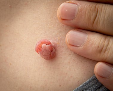 Sıvı nitrojenle yapılan tıbbi dermatolog tedavisinden şişmiş ve büyümüş bir insan vücudundaki deri ya da deri beninin yakın fotoğrafını çek. Deri benini aldırdım. Dermatolojik güzellik tedavisi