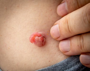 Sıvı nitrojenle yapılan tıbbi dermatolog tedavisinden şişmiş ve büyümüş bir insan vücudundaki deri ya da deri beninin yakın fotoğrafını çek. Deri benini aldırdım. Dermatolojik güzellik tedavisi