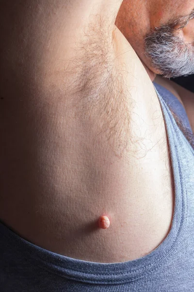 Close Up photo of skin tag or skin mole on a human body before medical dermatologist treatment with liquid nitrogen. Skin mole tag removal. Dermatological beauty treatment