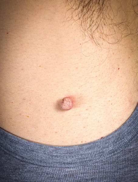 Close Up photo of skin tag or skin mole on a human body before medical dermatologist treatment with liquid nitrogen. Skin mole tag removal. Dermatological beauty treatment
