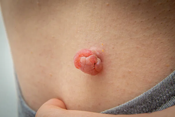 Close Up photo of skin tag or skin mole on a human body swollen and enlarged from the medical dermatologist treatment with liquid nitrogen. Skin mole tag removal. Dermatological beauty treatment