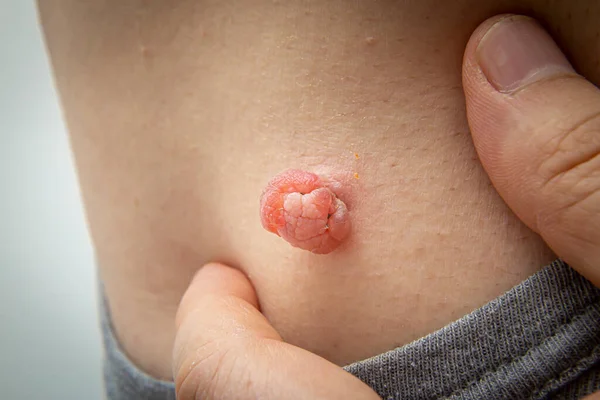 Close Up photo of skin tag or skin mole on a human body swollen and enlarged from the medical dermatologist treatment with liquid nitrogen. Skin mole tag removal. Dermatological beauty treatment