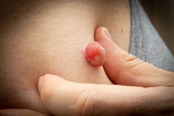 Close Up photo of skin tag or skin mole on a human body swollen and enlarged from the medical dermatologist treatment with liquid nitrogen. Skin mole tag removal. Dermatological beauty treatment