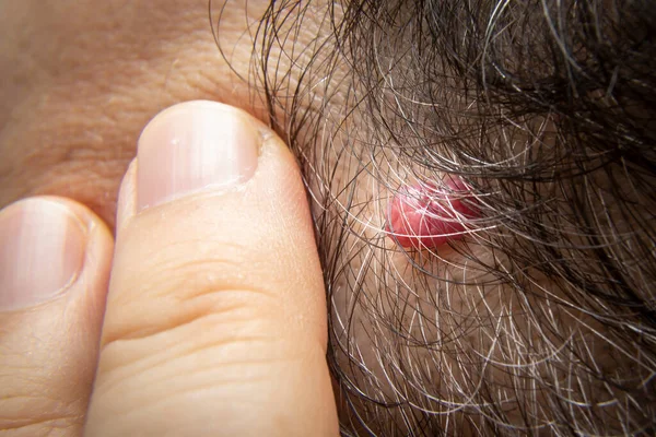 Foto Cerca Etiqueta Piel Angioma Cereza Lunar Cabeza Humana Cabello —  Fotos de Stock