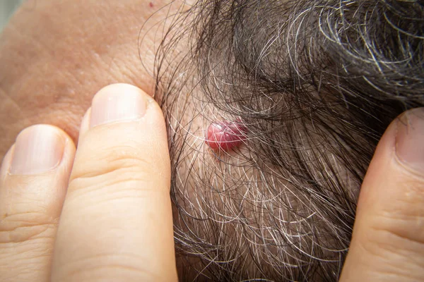 Closeup Photo Cherry Angioma Skin Tag Skin Mole Human Head — Stock Photo, Image