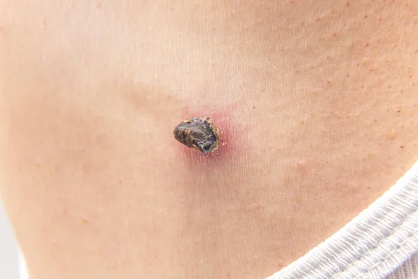 Skin tag or skin mole on a human body darkened, scorched and dried up after medical dermatologist treatment with liquid nitrogen. Skin mole tag removal. Dermatological beauty treatment
