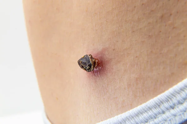 Skin Tag Skin Mole Human Body Darkened Scorched Dried Medical — Stock Photo, Image