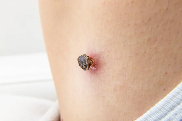 Skin Tag Skin Mole Human Body Darkened Scorched Dried Medical — Stock Photo, Image