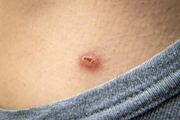 Little scar on the skin on a human body after the medical dermatologist treatment with liquid nitrogen to remove the skin tag or skin mole. Skin mole tag removal. Dermatological beauty treatment