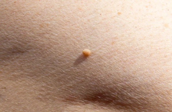 Närbild Foto Hud Tagg Eller Hud Mullvad Människokropp Dermatologisk Undersökning — Stockfoto