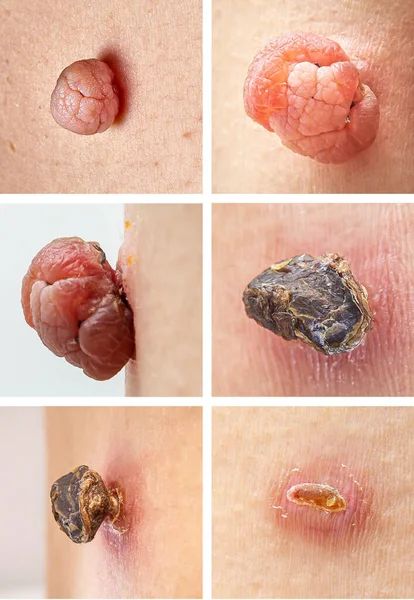 Step by step stages of the skin tag mole removal process using liquid nitrogen. Dermatological beauty treatment