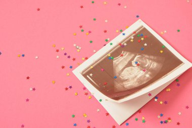 Pembe arka planda bir ultrason resmi yıldız şeklinde konfeti, cinsiyet partisi konsepti, bebek sahibi olmanın keyfi