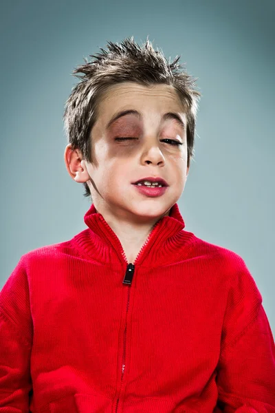 Trieste jongen met een bloeduitstorting onder één oog — Stockfoto