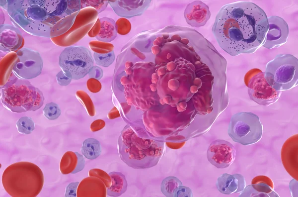 Острый Лимфобластный Лейкоз Раковые Клетки Кровотоке Взгляд Крупным Планом Иллюстрация — стоковое фото