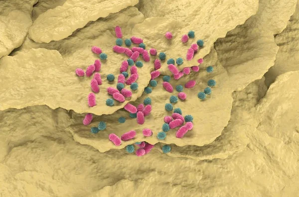 Finger nail, toe nail fungus infection isometric view - 3d illustration