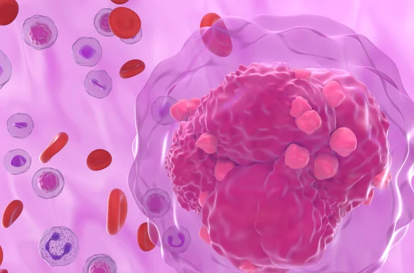 Kan Akışında Akut Lenfoblastik Lösemi All Kanser Hücresi Süper Yakın — Stok fotoğraf