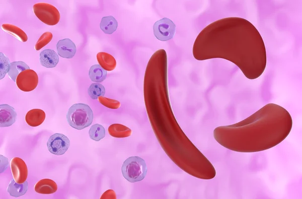 Anemia Falciforme Malattia Falciforme Scd Cellule Nel Flusso Sanguigno Vista — Foto Stock