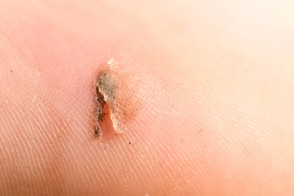 Close Painful Wound Macro Wound Human Skin Sand Particles Visible — Stock Photo, Image