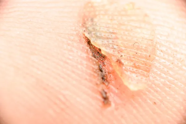 痛みを伴う傷を閉じる 人間の皮膚にマクロな傷 傷の中に砂粒子が見える — ストック写真