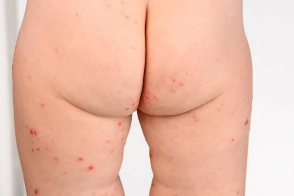 Erupção Cutânea Maculopapular Pele Pernas Uma Criança Infetada Por Febre — Fotografia de Stock