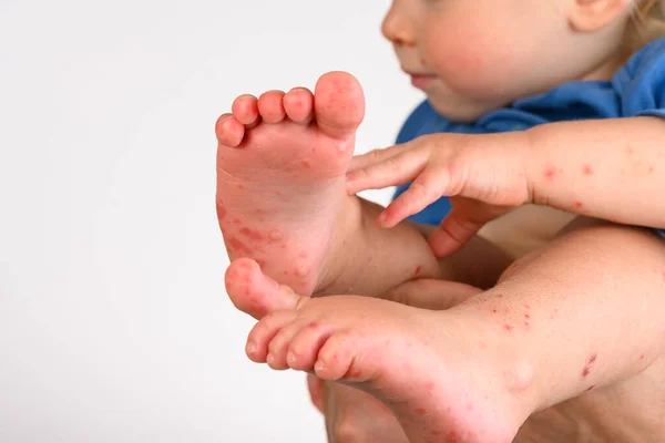 Zavřít Enterovirus Dětském Těle — Stock fotografie