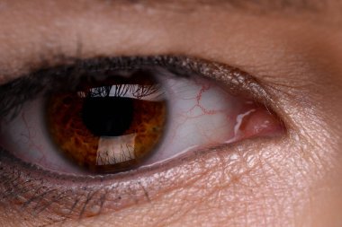 Göz retinası hastalığı var. Kırmızı iltihaplı ve genişlemiş kılcal damarlı kadın gözünün yakın çekimi..