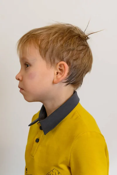 Injury Boy Head Falling Collision Hematoma Eye Child Standing Sideways — Stock Photo, Image