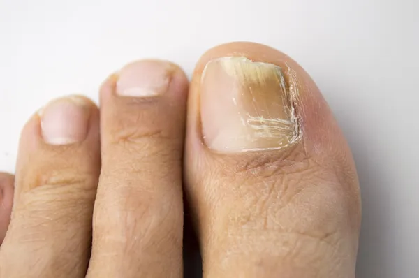 Грибковая инфекция ногтей — стоковое фото