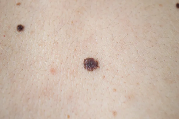 Skupina melanomy na zadní straně muž — Stock fotografie
