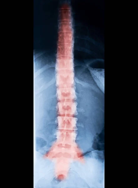 x-ray of spine skeleton. Red pain on the bones