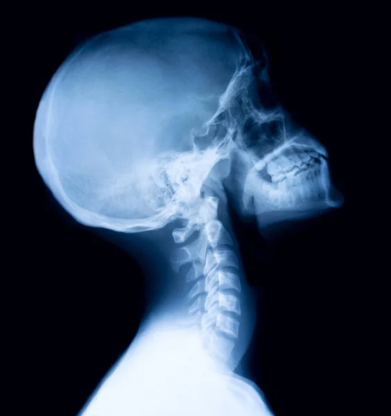 Film Röntgenschädel Und Halswirbelsäule Seitenansicht — Stockfoto
