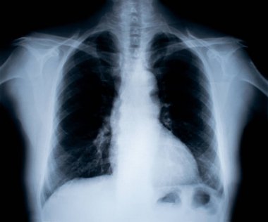 X-Ray görüntü üzerine beyaz izole