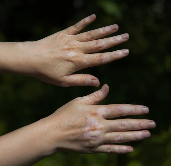 Vitiligo deri durum ile el