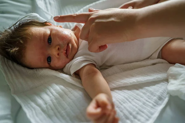 Neurodermatitis Eccema Atópico Constitucional Crónico Pequeño Bebé Recién Nacido Con —  Fotos de Stock