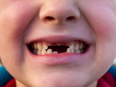 ağız diş değişen çocuk