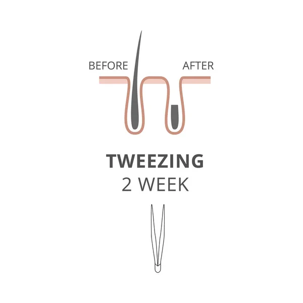 Tweezing Body Hair Removal Epilation Method Result Two Weeks Flat — Vector de stock