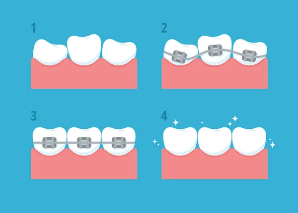 Correction Crooked Teeth Set Vector Flat Illustrations Beautiful Correction Teeth — Stock Vector