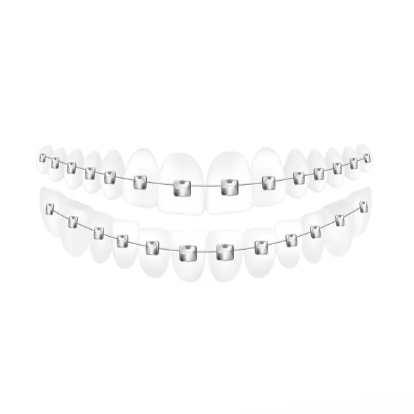 Zęby Szelkami Dentystycznymi Wyrównywania Zębów Realistyczna Ilustracja Wektorowa Izolowana Białym — Wektor stockowy