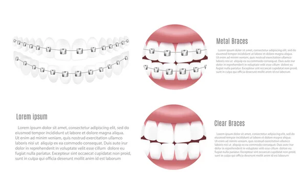 Diseño Pancartas Carteles Para Odontología Que Muestra Frenos Dentales Metálicos — Archivo Imágenes Vectoriales