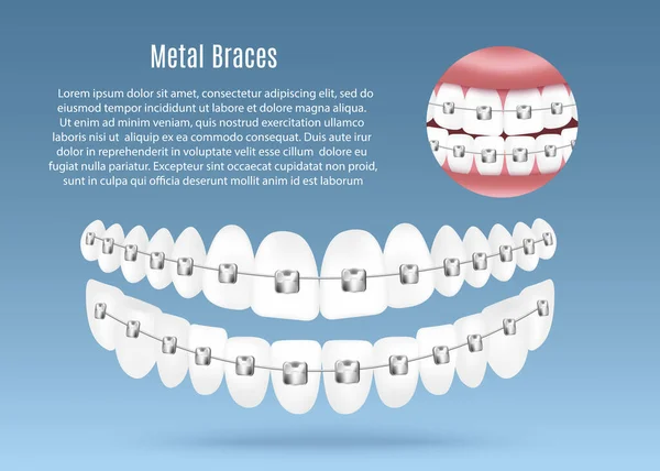 Metal Dental Dentes Suspensórios Publicidade Banner Mockup Ilustração Vetorial Realista —  Vetores de Stock
