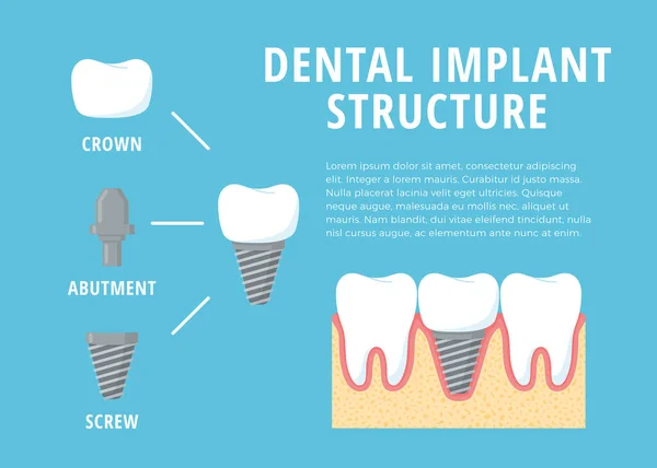 Tratamento Dentário Doente Implante Dentário Procedimento Dentário Dentaduras Ilustração Vetorial —  Vetores de Stock
