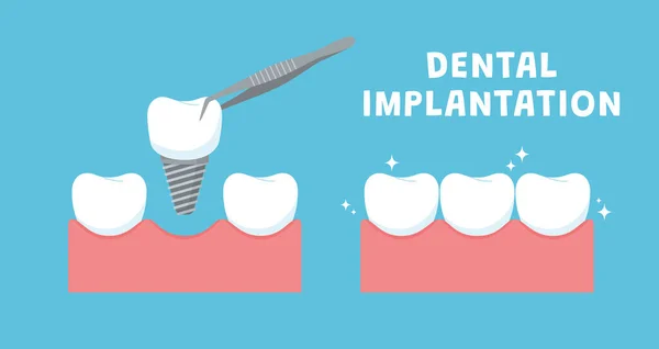 Estandarte Implantação Dentária Layout Cartaz Banner Background Dentistry Services Implantology —  Vetores de Stock